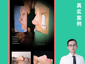 Dr·汤玉祥亲塑肋骨鼻综合