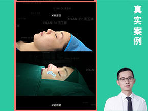 上海汤玉祥肋骨鼻综合案例